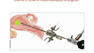 Histeroscopia cirúrgica [upl. by Eatnwahs]