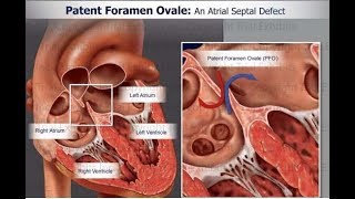 Patent foramen ovale PFO Part II [upl. by Godderd939]