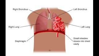 Diaphragmatic Hernia [upl. by Notslah]