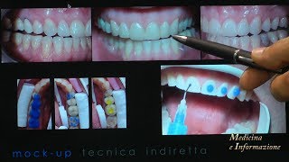 Odontoiatria Estetica Faccette le ultime novità di materiali e tecniche [upl. by Atcele600]