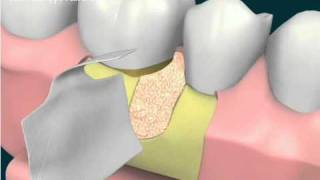 Rigenerazione tissutale guidata difetto mesiale di molare inferiorewmv [upl. by Brufsky]