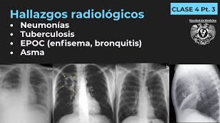 043  Neumonía TB EPOC Enfisema Bronquitis Bronquiectasias Asma [upl. by Sybley]