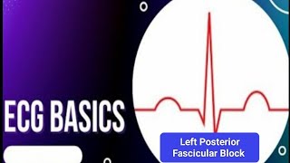 ECG Basics  Left Posterior Fascicular Block ECG Criteria and Electrophysiology of LPFB [upl. by Haff132]