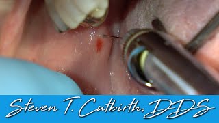 Painless and Profound Mandibular Block  Dental Minute with Steven T Cutbirth DDS [upl. by Egor]