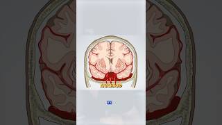 Subarachnoid hemorrhage is the result of a brain aneurysm brain brainbleed doctor medical [upl. by Nelyk]