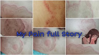 Ringworm KharishTinea Cruris How I Recover After 6 Month Complete Detail Vedio On Skin خارش چمبل [upl. by Tiduj]