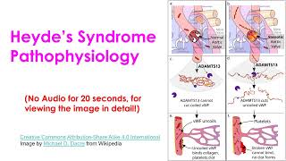 Heyde’s Syndrome in Severe Aortic Stenosis [upl. by Legin]