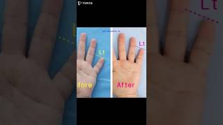 brachydactyly brachydactylytypeD 短指症手術 短指症 大拇指短粗 マムシ指 しゃもじ指 まむし指 우렁손톱 단지증 단지증수술 단지증수술후기 [upl. by Gerius579]