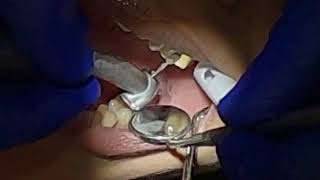 Crown Preparation Tooth 14 POV [upl. by Wernda]