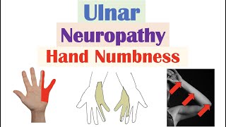 Ulnar Neuropathy amp Numbness in the Hand  Causes Signs amp Symptoms Diagnosis Treatment [upl. by Tigirb715]