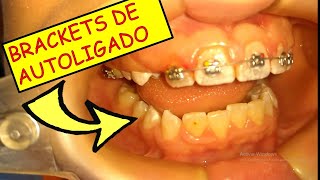 Los brackets de autoligado Cómo son y cómo funcionan😎 [upl. by Weisman107]