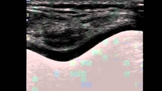 Musculoskeletal Ultrasound Knee 6 Suprapatellar Transverse Scan in Maximal Flexion [upl. by Azeria924]