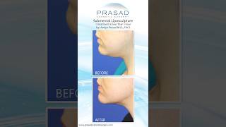 Safe Double Chin Removal in One Treatment Session doublechin [upl. by Durrell438]