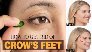 How to Get Rid of Crow’s Feet without Botox  Home Remedies for Crows Feet [upl. by Nosyaj]