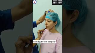 Chin Liposuction In Delhi Mumbai Bangalore Kolkata Hyderabad Chandigarh Nagpur Raipur Surat Chennai [upl. by Yelloh629]