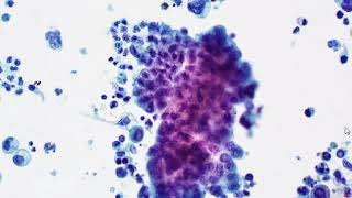 Urine Polyoma Virus and Urothelial Carcinoma [upl. by Neltiac]