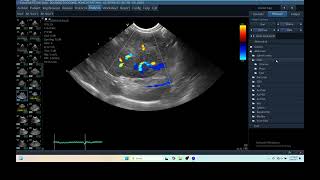 IQ 279 LIVER ULTRASOUND HEPATOMA ECHOPAC ANALYSIS ECHOCARDIOGRAPHY COLOR FLOW MAPING [upl. by Hyps202]