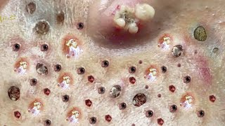 Blackhead Removal With Sac Dep Spa 100074051 [upl. by Esadnac]