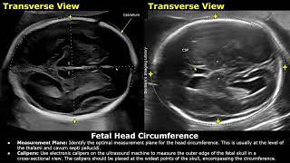 How To Measure Fetal Head Circumference HC On Ultrasound  Biometric Parameters  Obstetric USG [upl. by Rehpotsihrc]