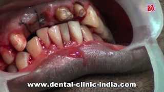 Laser Crown Lengthening Bangalore  Cosmetic Gum Surgery [upl. by Carlson]