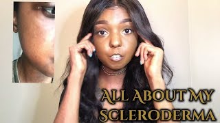 Living With Scleroderma  All about my scleroderma [upl. by Leuams332]