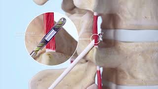 ReActiv8 Implant Procedure [upl. by Phipps]