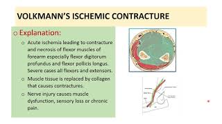 VOLKMANNS ISCHEMIC CONTRACTURE Anatomical Aspects [upl. by Sama]