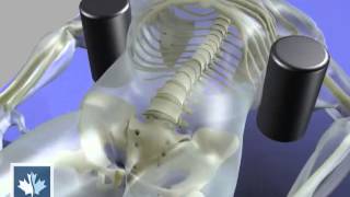 Sciatica  Spinal Decompression  Back Clinics of Canada [upl. by Llemhar]