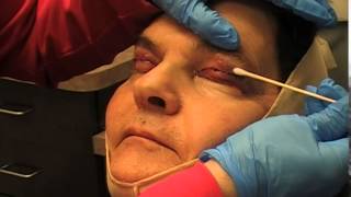 Blepharoplasty and Facelift Recovery  Carmel IN Dr Mark Hamilton [upl. by Oneill488]