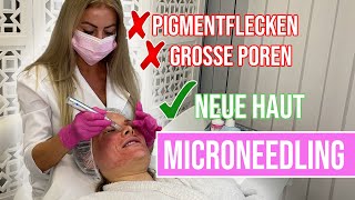 MICRONEEDLING Behandlung gegen Pigmentflecken und grosse Poren [upl. by Aydne]