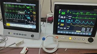 Multipara Monitor Edan X12 and Northern Meditech Virgo at Nivan Healthcare M 8826422220 edan [upl. by Melc]