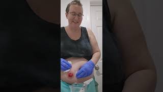 ileostomy output during appliance change and tips hollister ostomy output stoma support [upl. by Taylor]