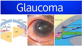 Glaucoma 1  Anatomy PhysiologyDefinition Classification amp Theories [upl. by Hite978]