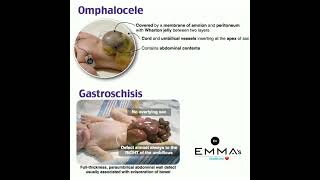 💠 Omphalocele Vs Gastroschisis 💠 [upl. by Ratha]