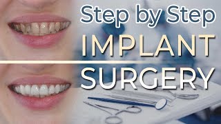 Dental Implant Surgery  Step by Step 57 Reestablishment of Anterior Canine Guidance [upl. by Ottavia435]