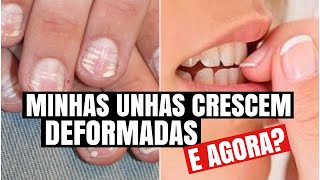 MINHAS UNHAS CRESCEM ARREBITADAS O QUE FAZER rafaresponde [upl. by Angelina262]