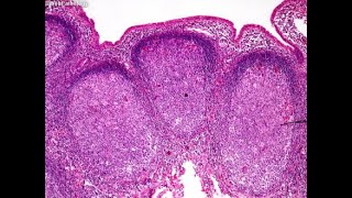 Robbins amp Cotran Pathologic Basis of Disease Chapter 13 White Blood Cell Path part 1 audiobook [upl. by Meekar]