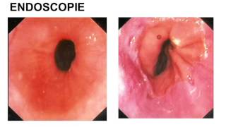 reflux gastro oesophagien et allergie alimentaire partie 2 [upl. by Gallenz]