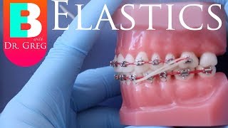 BRACES EXPLAINED Elastics  Rubber Bands [upl. by Chisholm]