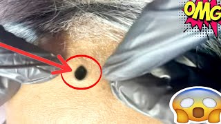 blackheads extractions  blackheads extractions [upl. by Weide]