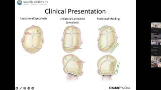 Craniosynostosis [upl. by Tharp10]