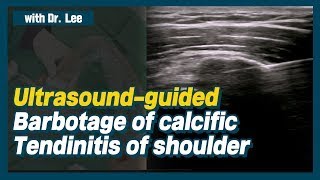 TrailerUltrasoundguided lavage of calcific tendinitis of shoulder ruptured calcification [upl. by Notirb]