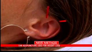 Ear Acupuncture Used For Weight Loss [upl. by Warga]