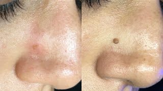 Fibroblast Treatment Results [upl. by Latnahc]