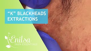 More Blackhead Extractions with K [upl. by Albers713]