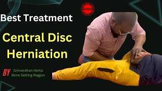 A Central Disc Herniation Is A Rare Condition  Disc Herniation Recovery [upl. by Atinram73]