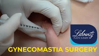 Gynecomastia Surgery Post Op Care Kenalog10 Shot [upl. by Ahsata]