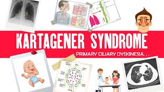 Kartagener syndrome Primary Ciliary Dyskinesia Immotile cilia syndrome triad mnemonic amp cause [upl. by Catharine]