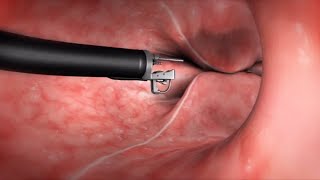 What Happens During the Endoscopic Sleeve Gastroplasty ESG Procedure [upl. by Jenesia]