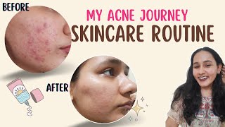 My Acne Journey  Skincare Routine  Adapalene  Breakout Control Serum  acne acnescars [upl. by Gilbye]